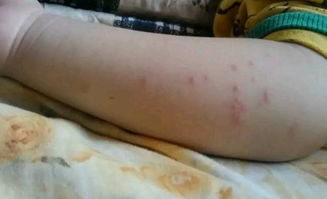 宝宝屁股长了很多红点点怎么办（宝宝屁股长一颗颗红点怎么办）